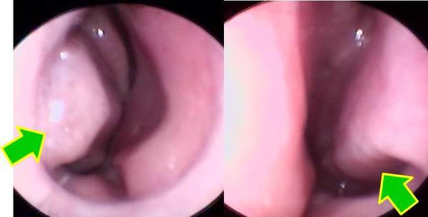 左図：右鼻腔<br />
右図：左鼻腔<br />
両側ともに下甲介の蒼白性腫脹（矢印）がみられます。
