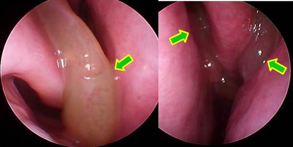 両鼻内に鼻茸を認めます（矢印）。