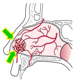 図:鼻腔内の血管走行<br />
鼻中隔前方に血管が集まるのがわかります。
