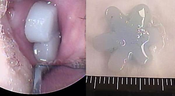 左図：鼻内に異物があります。<br />
右図：摘出した異物は1.5㎝大のスポンジ状の玩具でした。