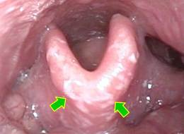 喉頭蓋に吸入薬が残っています（矢印）。