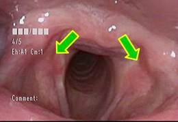 両側声帯の後方に発赤部位があります（矢印）。胃酸の逆流による逆流性食道炎が疑われます。
