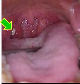右口蓋扁桃に膿栓があります（矢印）。膿栓は細菌やウイルスと戦った白血球の死骸と言われています。膿栓を除去することで症状は消失します。