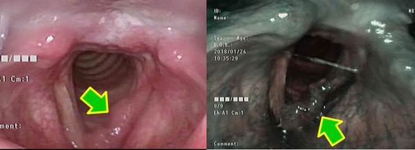 症例1（左）：通常光による観察です。前連合から左声帯にかけて隆起性の病変があります。<br />
症例1（右）：NBI内視鏡による観察です。通常光と同様の隆起性の病変があります。