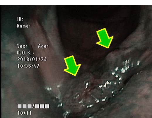 症例1（NBI内視鏡で近接）<br />
左声帯の隆起性病変に茶褐色の領域があるのがわかります。<br />
茶褐色の領域の中の部分が必ずしも均一でないことがわかります。<br />
喉頭癌を強く疑う病変です。