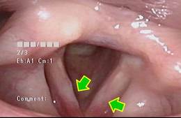 両側の声帯前方に発赤があります。両側声帯の中央に白苔がついています。