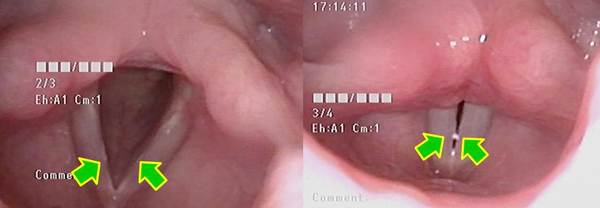 左図、吸気時：両側声帯膜様部中央にごく小さな隆起があります。<br />
右図、発声時：両側声帯膜様部中央に結節がある部位に痰があります