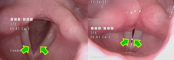 左図、吸気時：両側声帯膜様部中央にごく小さな隆起があります。<br />
右図、発声時：両側声帯膜様部中央に結節がある部位に痰があります