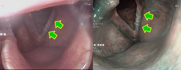 左図：左声帯膜様部に白色の病変があります。<br />
右図：NBI内視鏡では左声帯膜様部に白色の病変はありますが、癌の特徴である茶褐色の領域はありません。