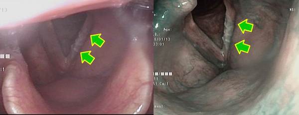 左図：左声帯膜様部に白色の病変があります。<br />
右図：NBI内視鏡では左声帯膜様部に白色の病変はありますが、癌の特徴である茶褐色の領域はありません。