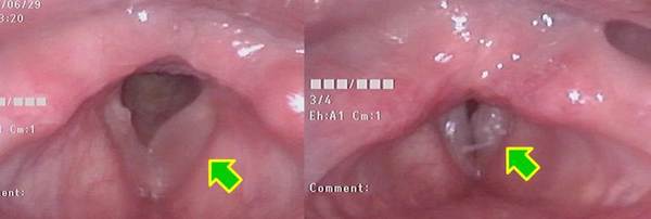 左図、吸気時：左声帯膜様部中央に浮腫状のポリープ様声帯があります（矢印）。<br />
右図、発声時：左声帯膜様部中央の声帯ポリープが発声時に声帯振動を妨げています（矢印）。