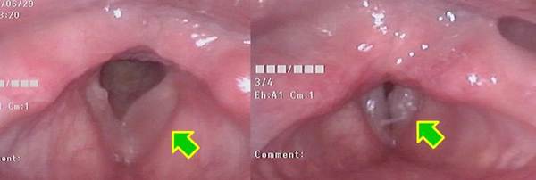 左図、吸気時：左声帯膜様部中央に浮腫状のポリープ様声帯があります（矢印）。<br />
右図、発声時：左声帯膜様部中央の声帯ポリープが発声時に声帯振動を妨げています（矢印）。
