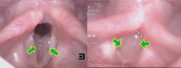 左図、吸気時：両声帯の内側に浮腫状のポリープ様声帯があります（矢印）。<br />
右図、発声時：左右のポリープ様声帯が発声時に声帯の上に乗っています（矢印）。