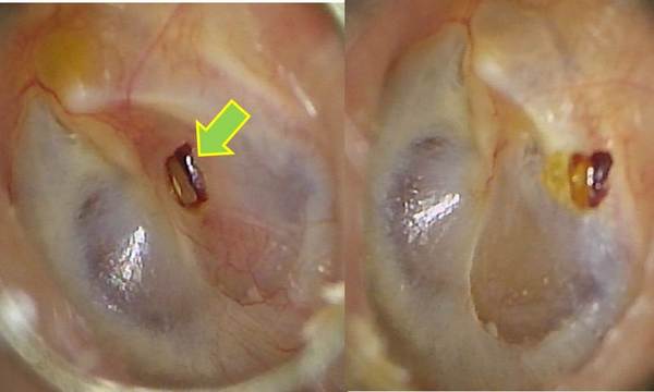 左図：鼓膜に穿孔があります（矢印）。<br />
右図：2週間経過後　鼓膜穿孔は自然に閉鎖しました。