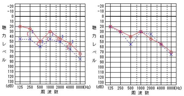 左図:鼓膜穿孔があった状態の聴力検査<br />
右図:鼓膜穿孔が閉鎖した状態の聴力検査<br />
左聴力が改善しているのがわかります。