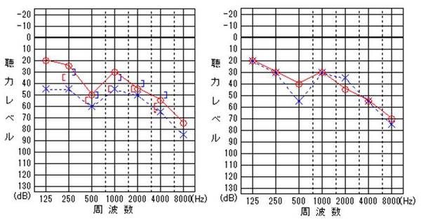 左図：鼓膜穿孔があった状態の聴力検査<br />
右図：鼓膜穿孔が閉鎖した状態の聴力検査<br />
左聴力が改善しているのがわかります。