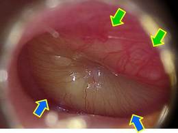 症例1：右急性中耳炎：後上象限の血管は発赤しており、腫脹も強いです（緑矢印）。<br />
前下象限に黄色の貯留液が貯留しており、腫脹しています（青矢印）。
