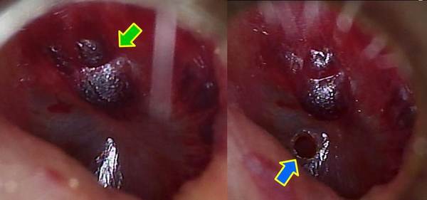 症例2．左図：左急性中耳炎：後上象限に出血した後があります（緑矢印）。<br />
症例2．右図：疼痛がとても強いため、OtoLAM™で左鼓膜切開術を行いました（青矢印）。
