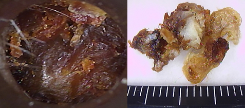 外耳道をほぼ占める巨大な耳垢。4㎝弱ありました。
